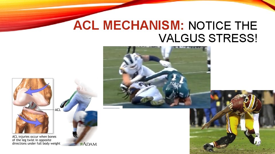 ACL MECHANISM: NOTICE THE VALGUS STRESS! 