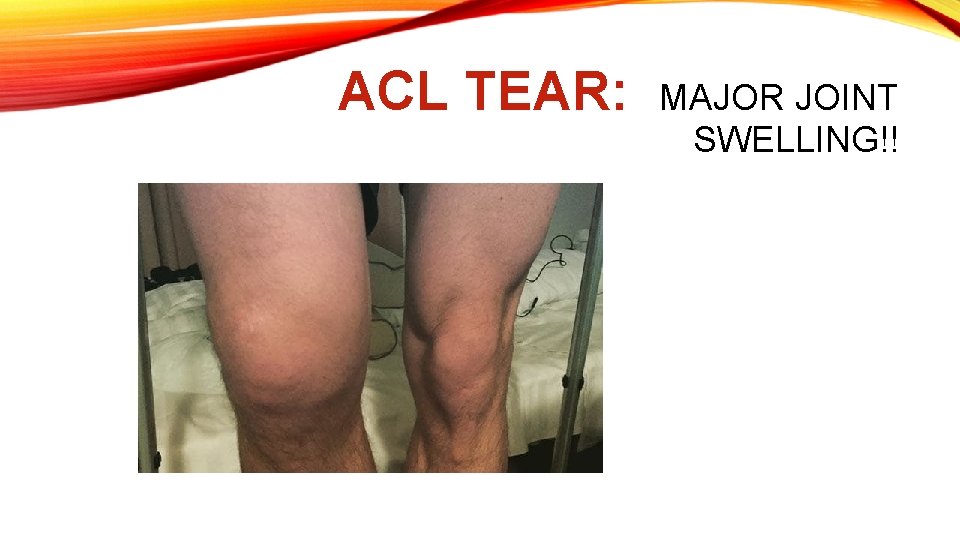 ACL TEAR: MAJOR JOINT SWELLING!! 