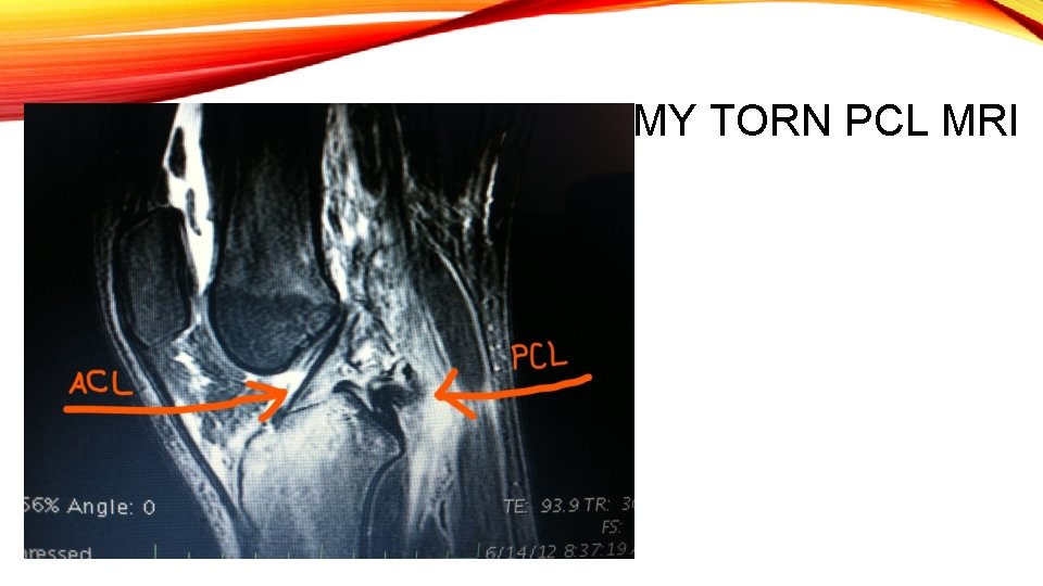 MY TORN PCL MRI 