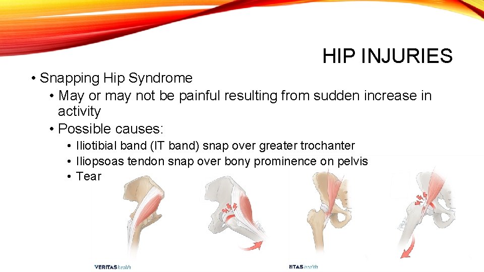 HIP INJURIES • Snapping Hip Syndrome • May or may not be painful resulting