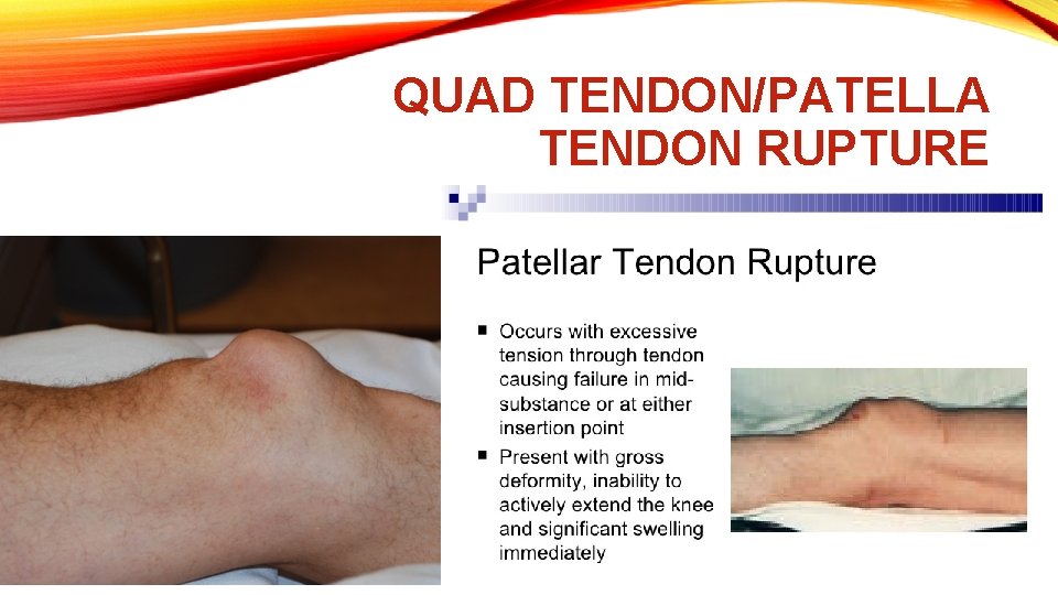 QUAD TENDON/PATELLA TENDON RUPTURE 