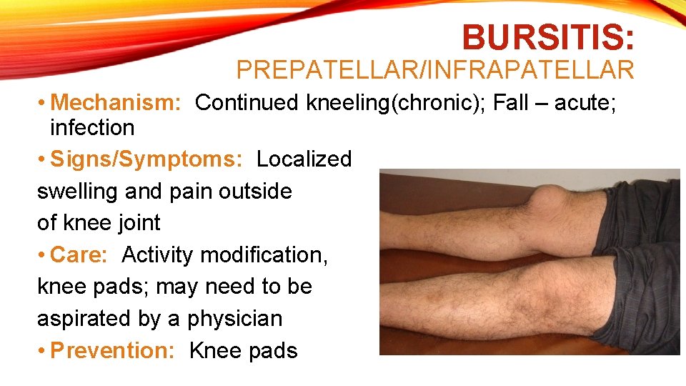 BURSITIS: PREPATELLAR/INFRAPATELLAR • Mechanism: Continued kneeling(chronic); Fall – acute; infection • Signs/Symptoms: Localized swelling