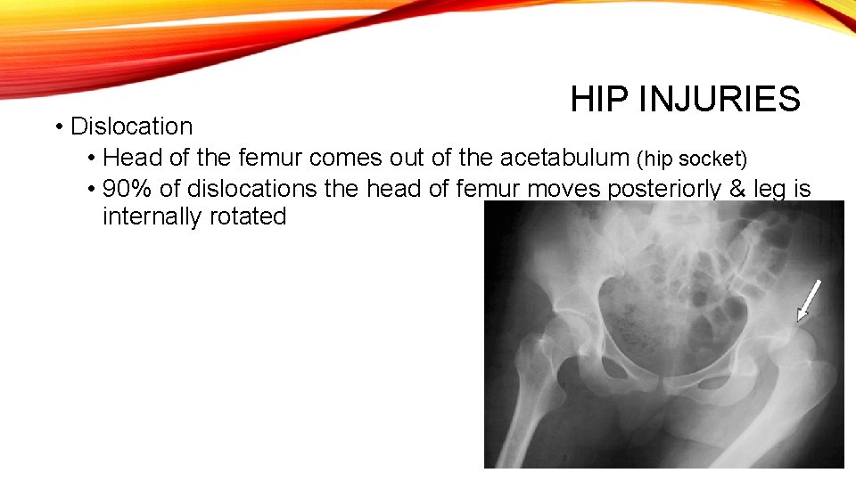 HIP INJURIES • Dislocation • Head of the femur comes out of the acetabulum