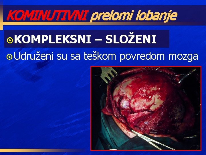 KOMINUTIVNI prelomi lobanje ¤KOMPLEKSNI ¤ Udruženi – SLOŽENI su sa teškom povredom mozga 