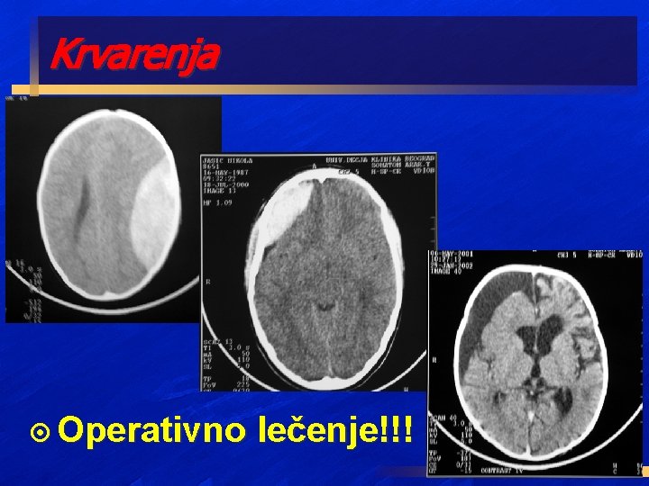 Krvarenja ¤ Operativno lečenje!!! 