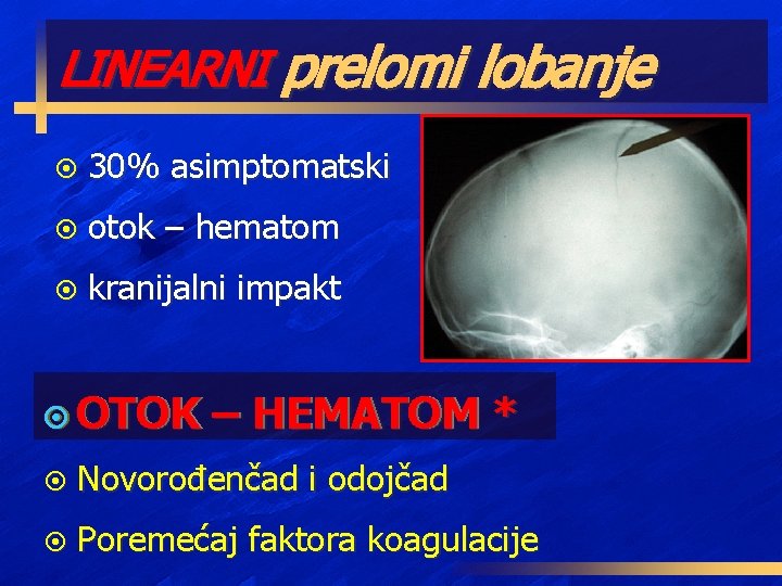 LINEARNI prelomi lobanje ¤ 30% asimptomatski ¤ otok – hematom ¤ kranijalni impakt ¤