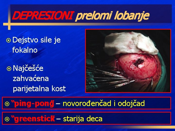 DEPRESIONI prelomi lobanje ¤ Dejstvo sile je fokalno ¤ Najčešće zahvaćena parijetalna kost ¤