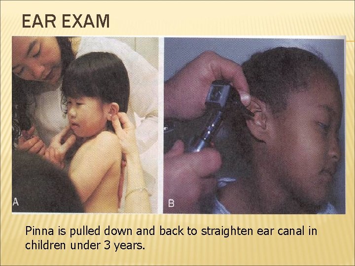 EAR EXAM Pinna is pulled down and back to straighten ear canal in children
