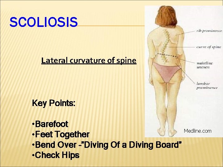 SCOLIOSIS Lateral curvature of spine Key Points: • Barefoot • Feet Together • Bend