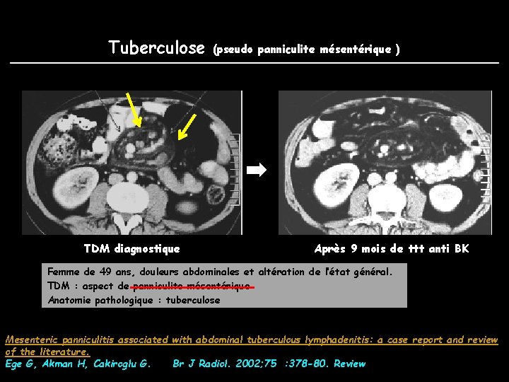 Tuberculose TDM diagnostique (pseudo panniculite mésentérique ) Après 9 mois de ttt anti BK