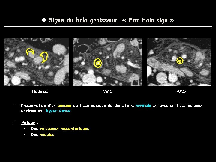  Signe du halo graisseux « Fat Halo sign » Nodules VMS AMS •