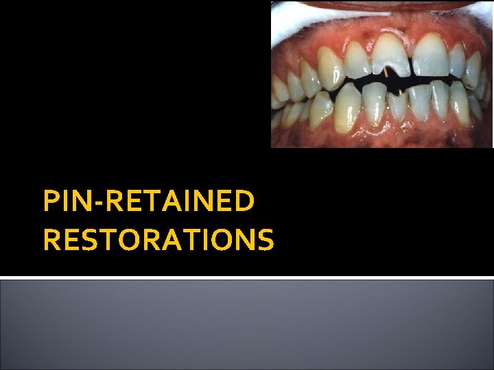 PIN-RETAINED RESTORATIONS 