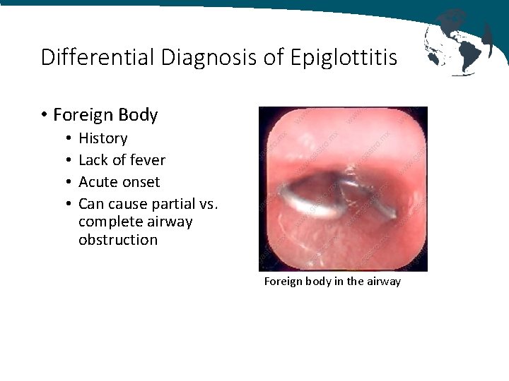 Differential Diagnosis of Epiglottitis • Foreign Body • • History Lack of fever Acute