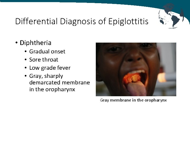 Differential Diagnosis of Epiglottitis • Diphtheria • • Gradual onset Sore throat Low grade