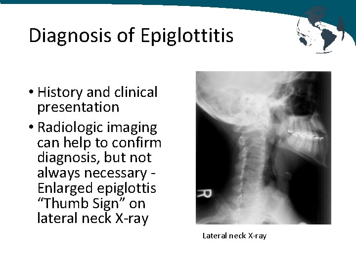 Diagnosis of Epiglottitis • History and clinical presentation • Radiologic imaging can help to