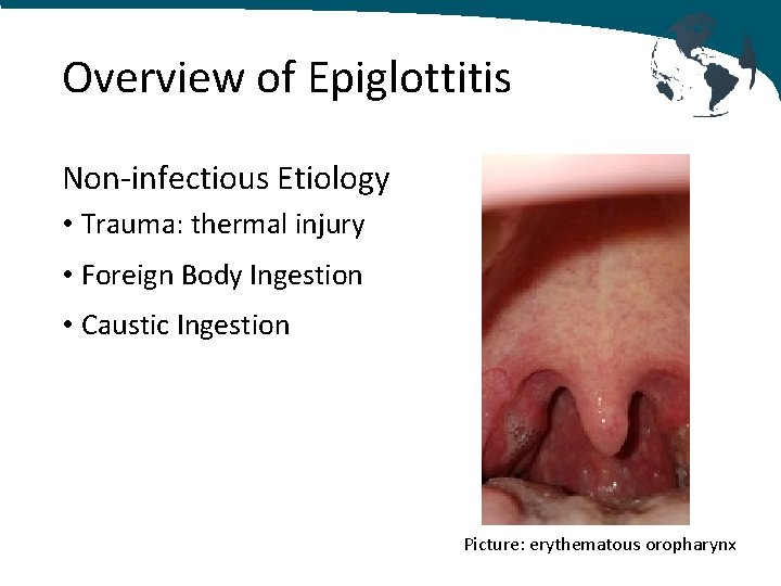 Overview of Epiglottitis Non-infectious Etiology • Trauma: thermal injury • Foreign Body Ingestion •