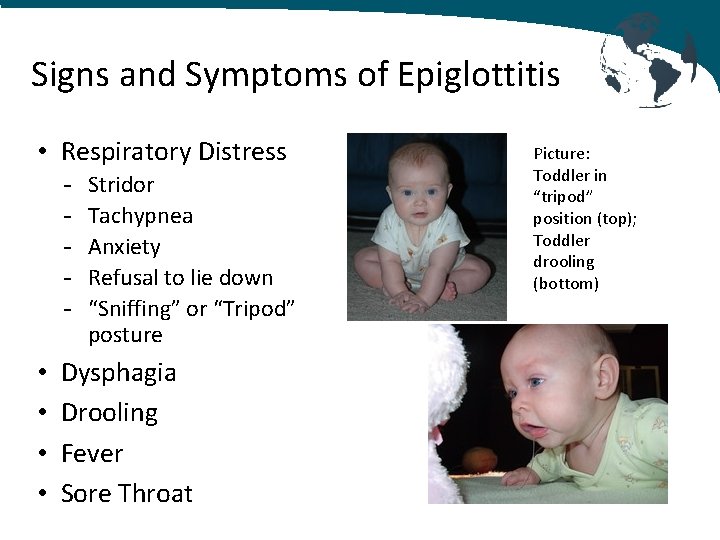 Signs and Symptoms of Epiglottitis • Respiratory Distress - • • Stridor Tachypnea Anxiety