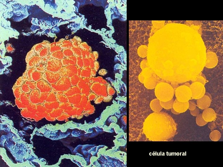 Cancro de pulmón célula tumoral 