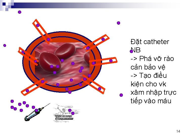 Đặt catheter NB -> Phá vỡ rào cản bảo vệ -> Tạo điều kiện