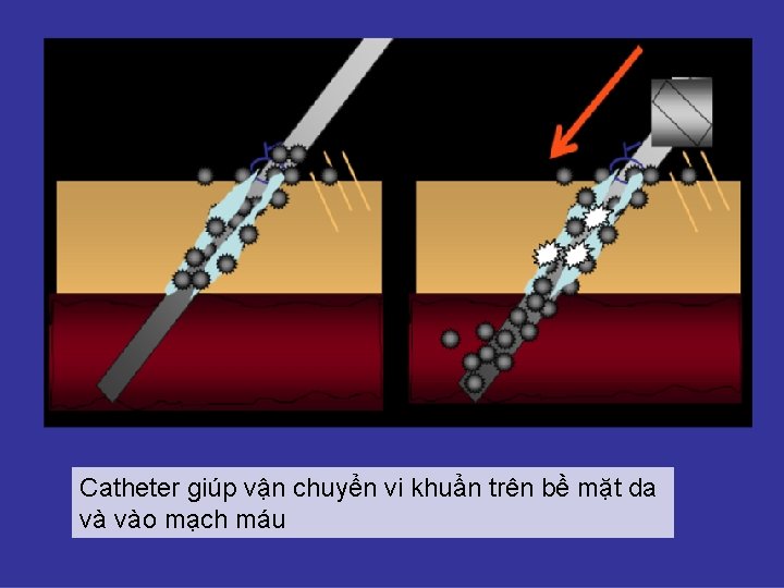 Catheter giúp vận chuyển vi khuẩn trên bề mặt da và vào mạch máu