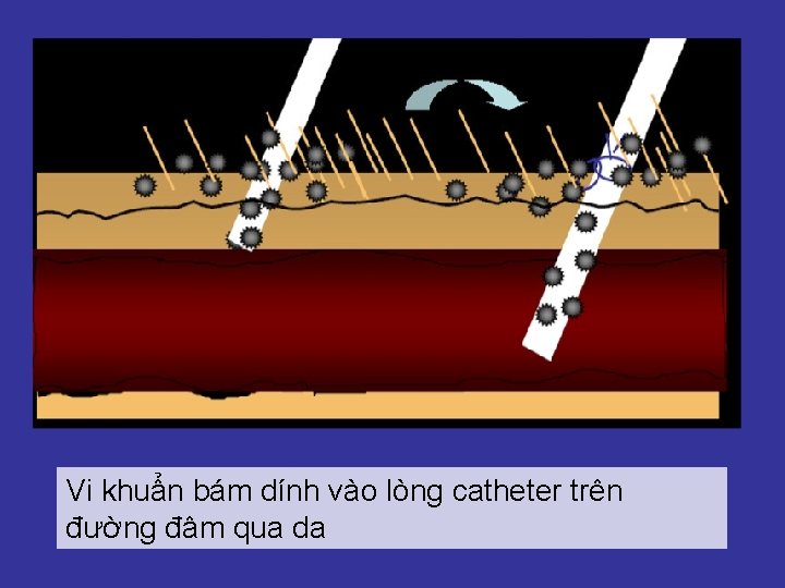 Vi khuẩn bám dính vào lòng catheter trên đường đâm qua da 