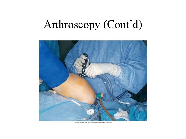 Arthroscopy (Cont’d) 