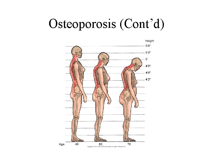 Osteoporosis (Cont’d) 