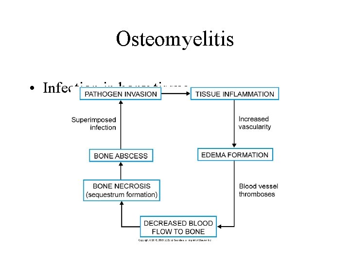 Osteomyelitis • Infection in bony tissue 