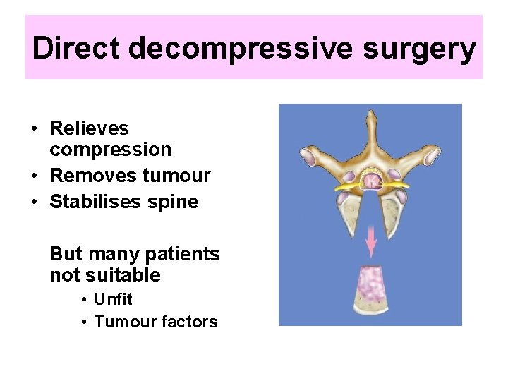 Direct decompressive surgery • Relieves compression • Removes tumour • Stabilises spine But many