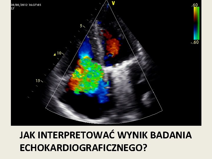 JAK INTERPRETOWAĆ WYNIK BADANIA ECHOKARDIOGRAFICZNEGO? 