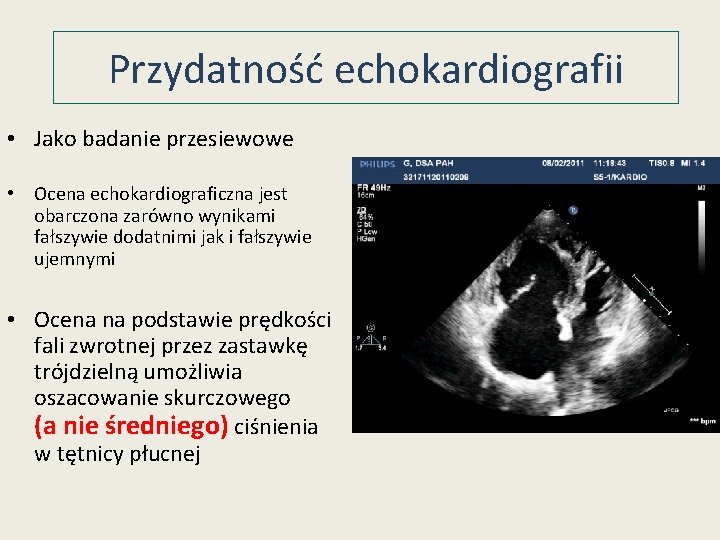 Przydatność echokardiografii • Jako badanie przesiewowe • Ocena echokardiograficzna jest obarczona zarówno wynikami fałszywie Przydatność echokardiografii • Jako badanie przesiewowe • Ocena echokardiograficzna jest obarczona zarówno wynikami fałszywie