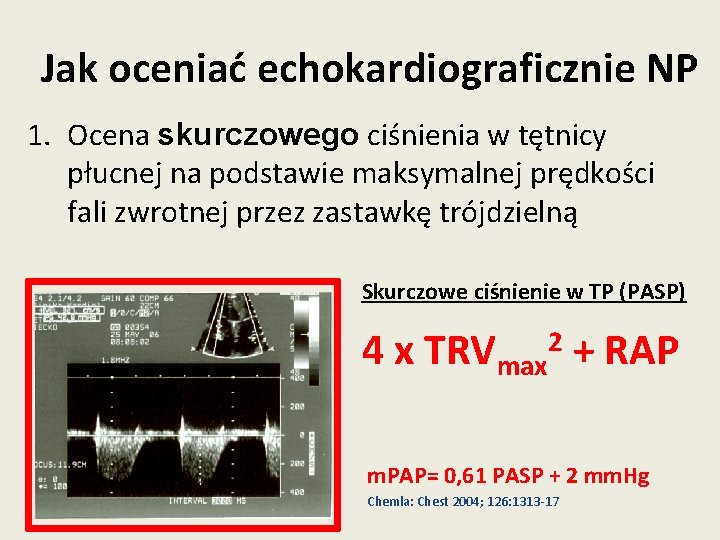 Jak oceniać echokardiograficznie NP 1. Ocena skurczowego ciśnienia w tętnicy płucnej na podstawie maksymalnej Jak oceniać echokardiograficznie NP 1. Ocena skurczowego ciśnienia w tętnicy płucnej na podstawie maksymalnej