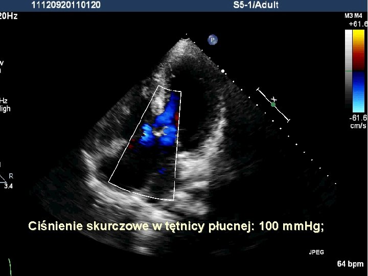 Ciśnienie skurczowe w tętnicy płucnej: 100 mm. Hg; Ciśnienie skurczowe w tętnicy płucnej: 100 mm. Hg;