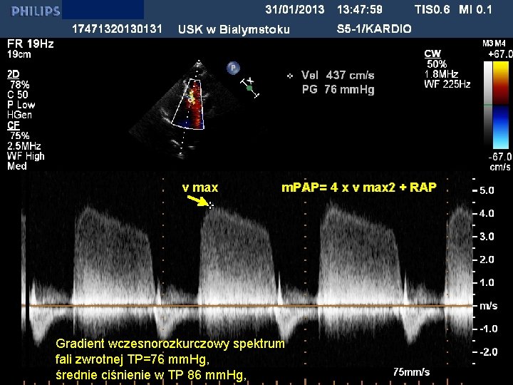 v max m. PAP= 4 x v max 2 + RAP Gradient wczesnorozkurczowy spektrum