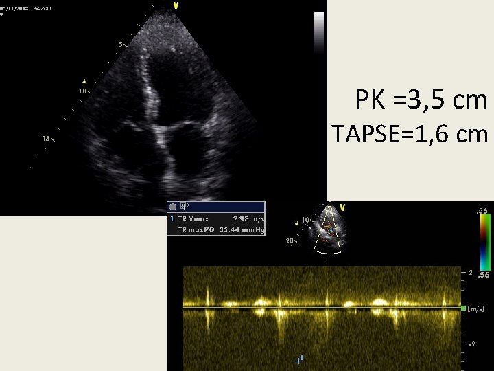 PK =3, 5 cm TAPSE=1, 6 cm 