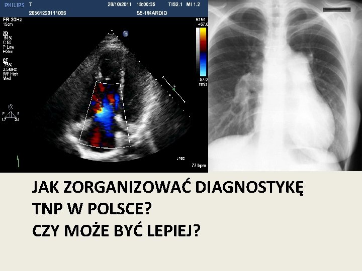 JAK ZORGANIZOWAĆ DIAGNOSTYKĘ TNP W POLSCE? CZY MOŻE BYĆ LEPIEJ? 