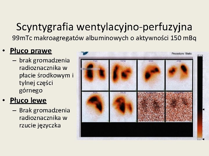 Scyntygrafia wentylacyjno-perfuzyjna 99 m. Tc makroagregatów albuminowych o aktywności 150 m. Bq • Płuco