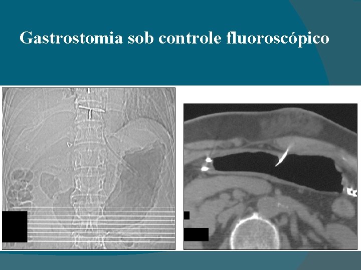 Gastrostomia sob controle fluoroscópico 