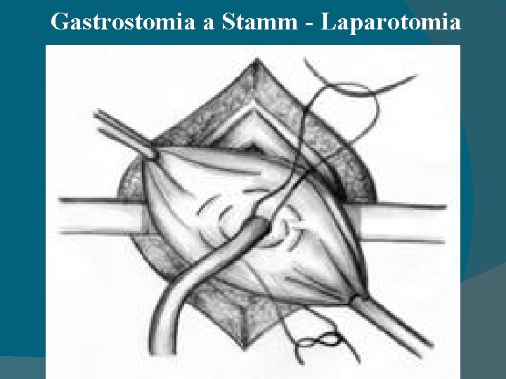 Gastrostomia a Stamm - Laparotomia 