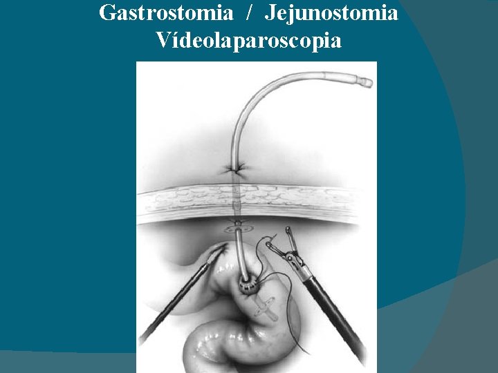 Gastrostomia / Jejunostomia Vídeolaparoscopia 