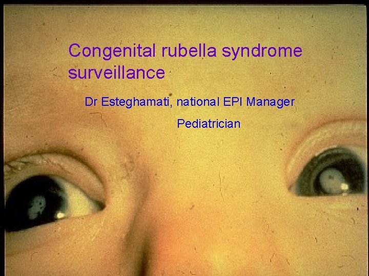 Congenital rubella syndrome surveillance Dr Esteghamati, national EPI Manager Pediatrician 