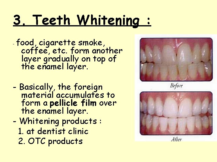 3. Teeth Whitening : - food, cigarette smoke, coffee, etc. form another layer gradually