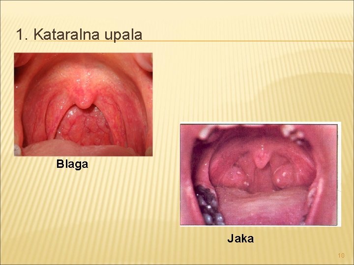 1. Kataralna upala Blaga Jaka 10 