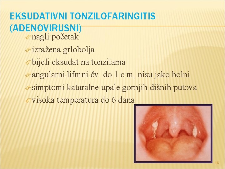 EKSUDATIVNI TONZILOFARINGITIS (ADENOVIRUSNI) nagli početak izražena grlobolja bijeli eksudat na tonzilama angularni lifmni čv.