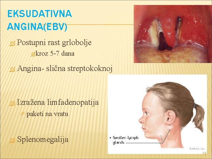 EKSUDATIVNA ANGINA(EBV) Postupni rast grlobolje kroz 5 -7 dana Angina- slična streptokoknoj Izražena limfadenopatija EKSUDATIVNA ANGINA(EBV) Postupni rast grlobolje kroz 5 -7 dana Angina- slična streptokoknoj Izražena limfadenopatija