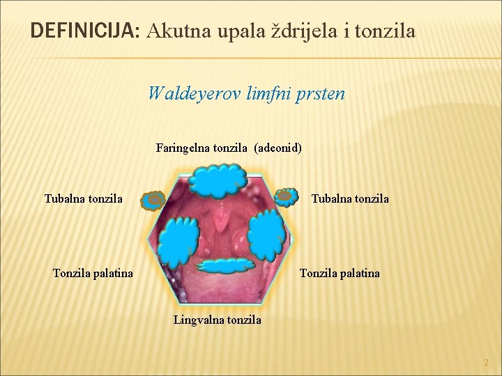 DEFINICIJA: Akutna upala ždrijela i tonzila Waldeyerov limfni prsten Faringelna tonzila (adeonid) Tubalna tonzila