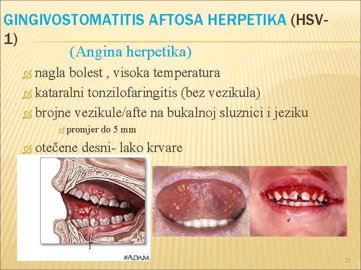 GINGIVOSTOMATITIS AFTOSA HERPETIKA (HSV 1) (Angina herpetika) nagla bolest , visoka temperatura kataralni tonzilofaringitis