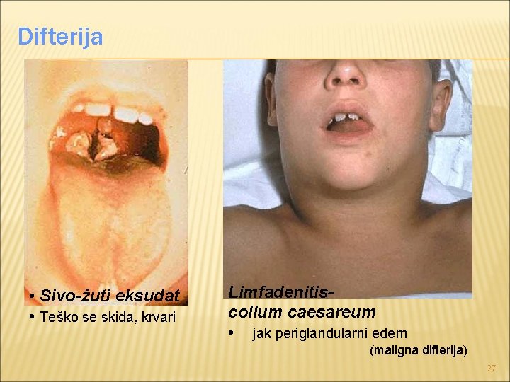 Difterija • Sivo-žuti eksudat • Teško se skida, krvari Limfadenitiscollum caesareum • jak periglandularni