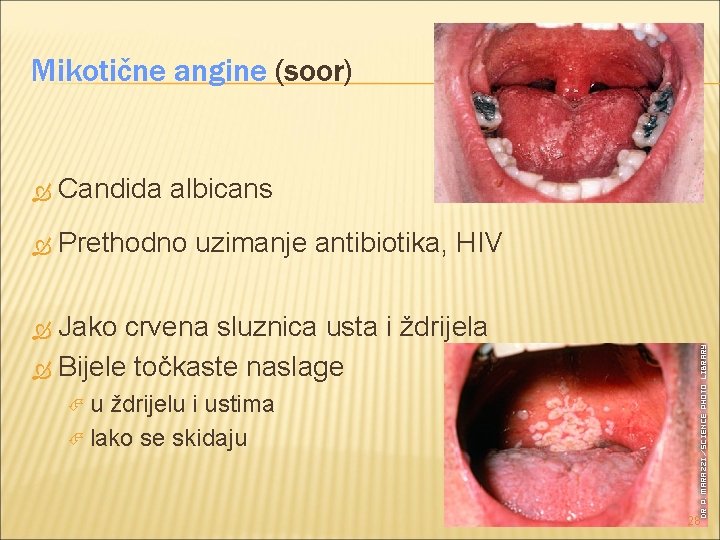 Mikotične angine (soor) Candida albicans Prethodno uzimanje antibiotika, HIV Jako crvena sluznica usta i