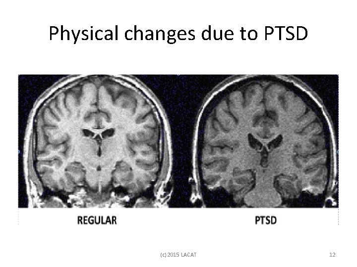 Physical changes due to PTSD (c) 2015 LACAT 12 